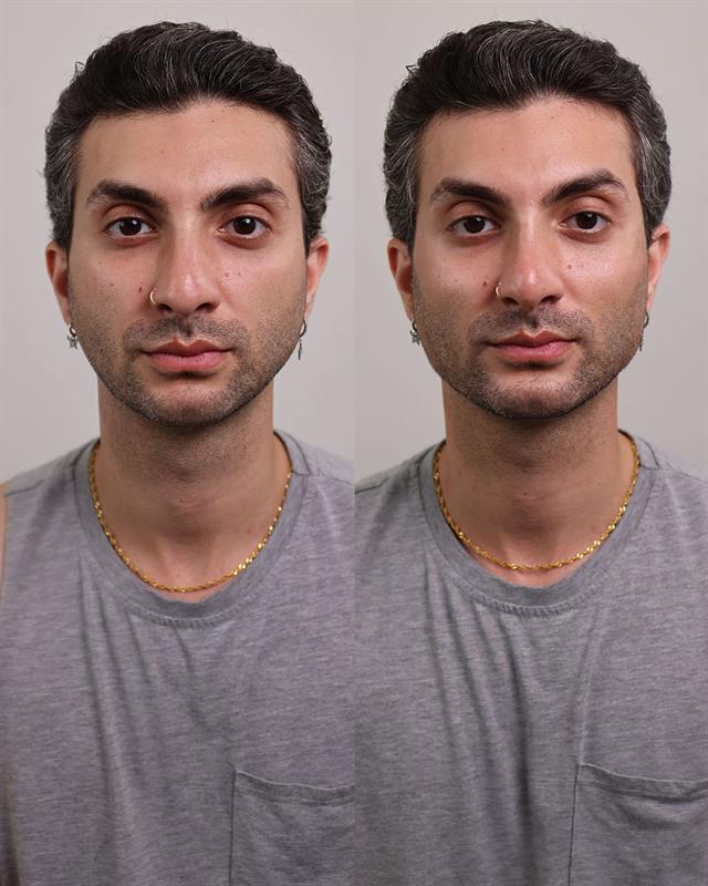 Unretouched before and after result, the drBand Clinic
