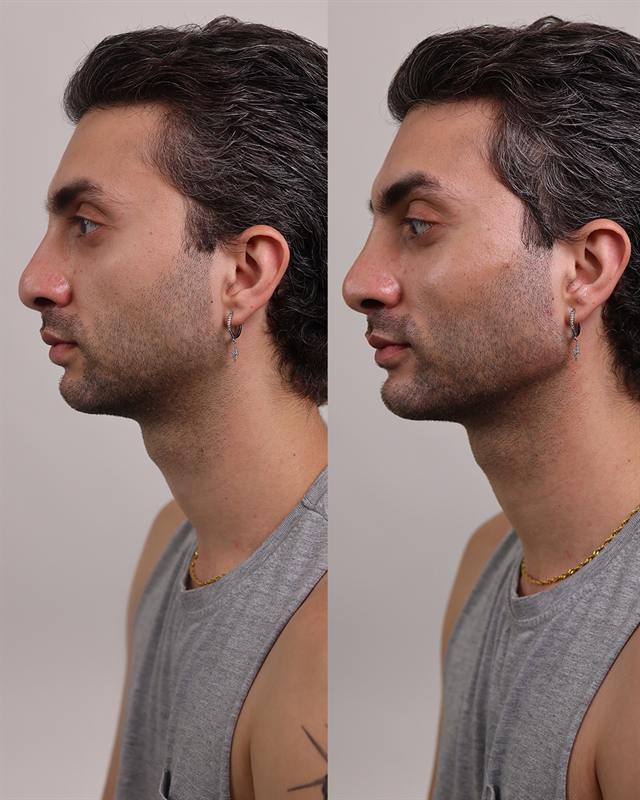 Unretouched before and after result, the drBand Clinic