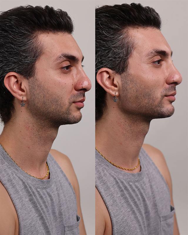 Unretouched before and after result, the drBand Clinic