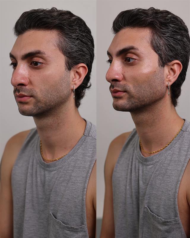 Unretouched before and after result, the drBand Clinic