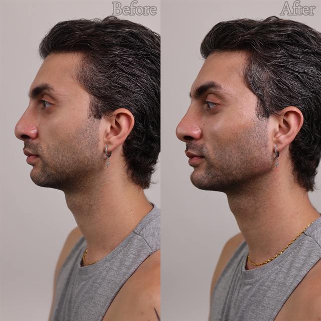Unretouched before and after result, the drBand Clinic