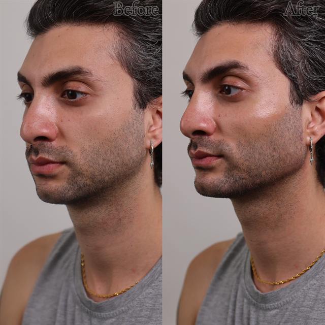 Unretouched before and after result, the drBand Clinic