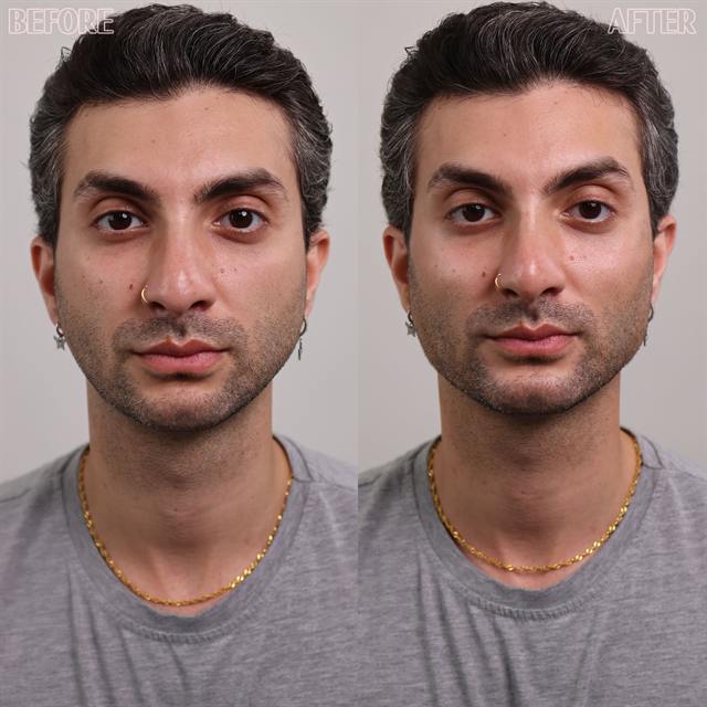 Unretouched before and after result, the drBand Clinic