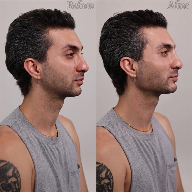 Unretouched before and after result, the drBand Clinic