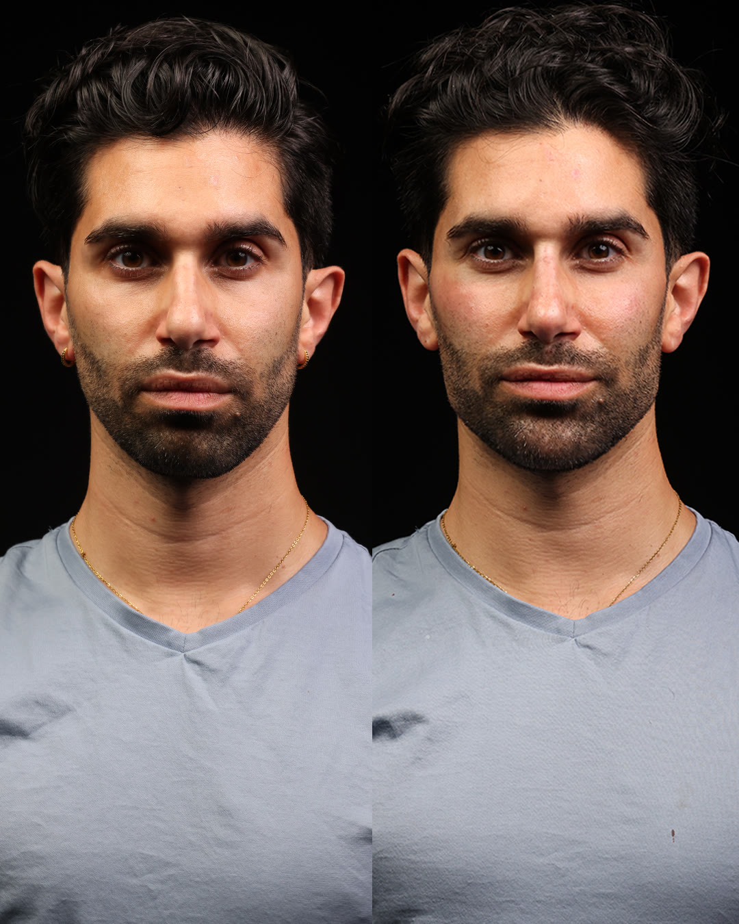 drBand patient before and after, cheeks and mid-face, front view, unretouched
