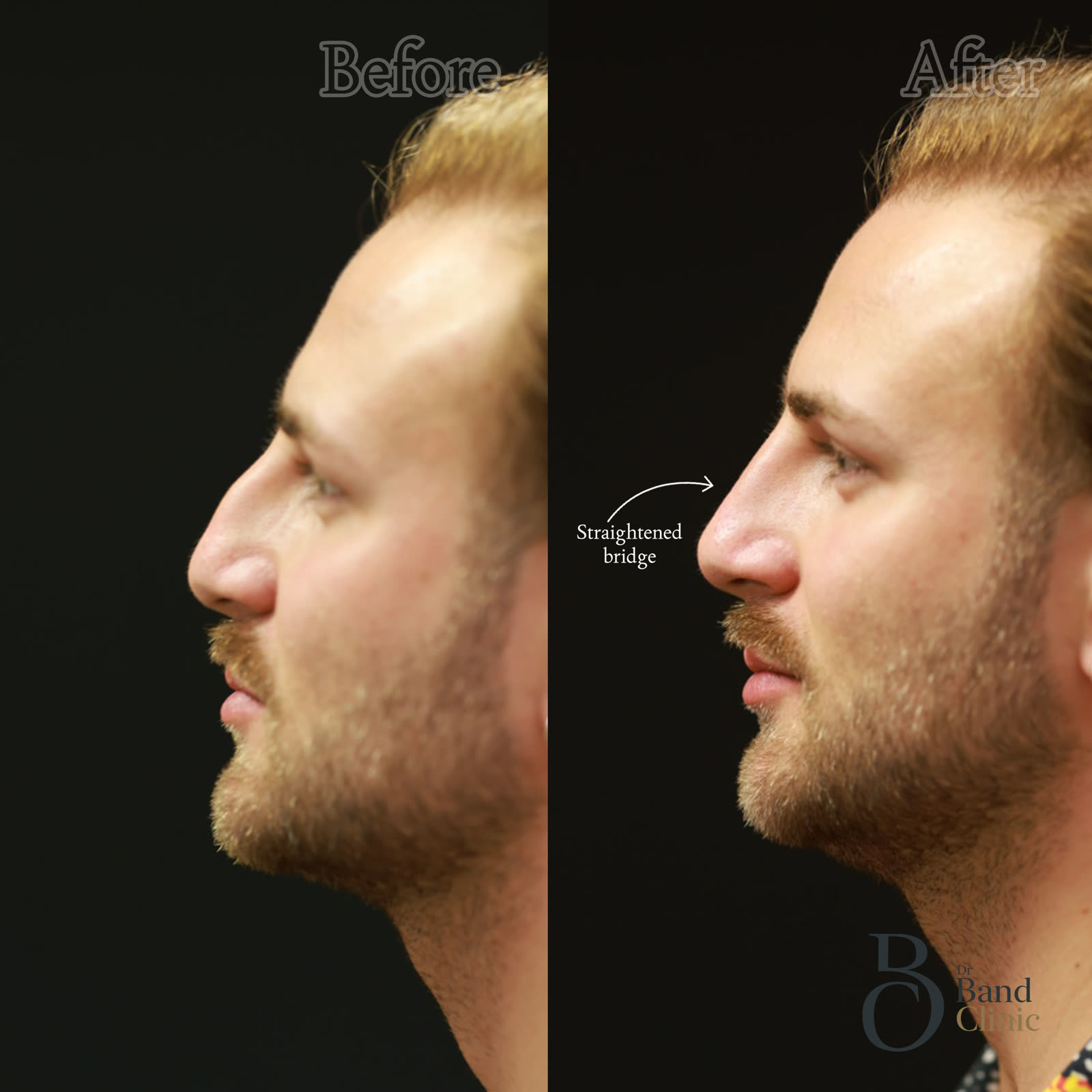 Non-surgical rhinoplasty, straightened profile, unretouched