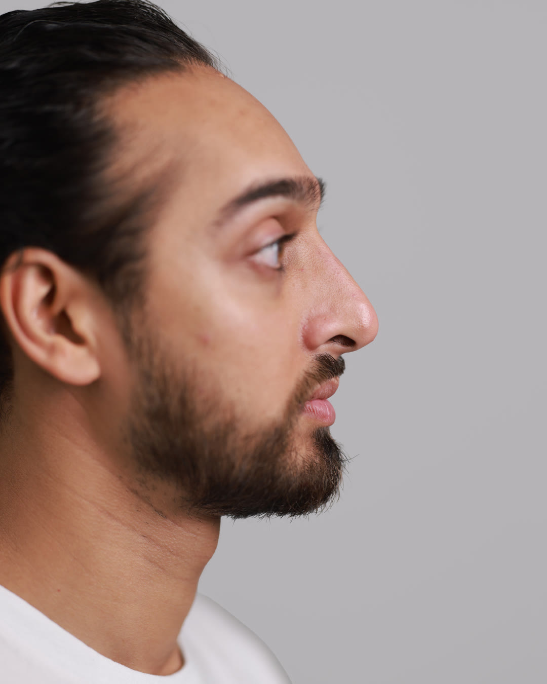 Male profile after non-surgical rhinoplasty, a straight masculine bridge, unretouched