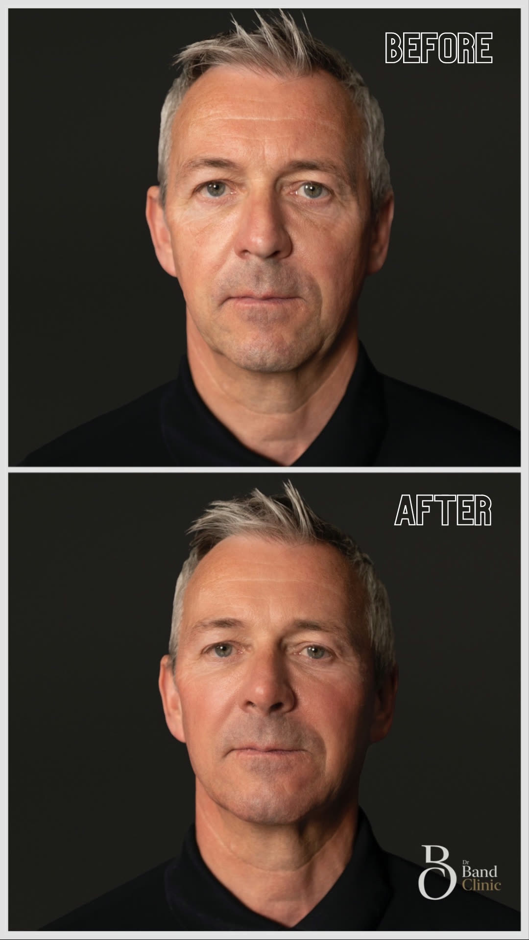 Full face restoration, unretouched