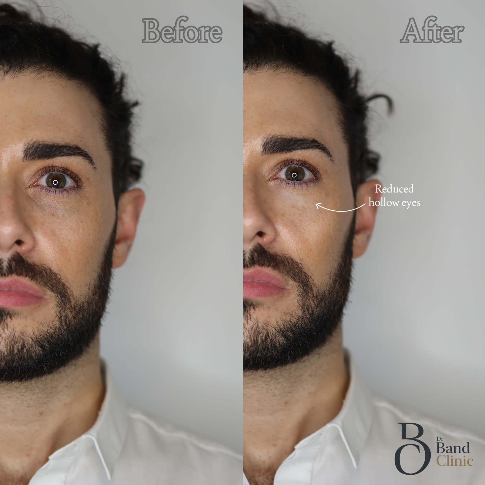 Tear-trough correction, under-eye shadow softened, unretouched