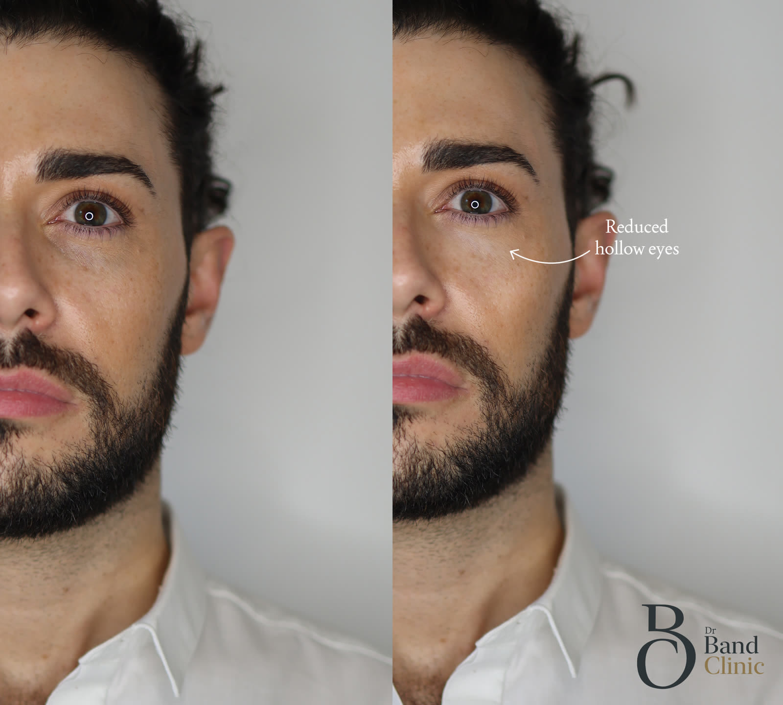 Tear-trough correction, unretouched drBand patient